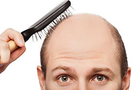 Hair Loss Hair Loss